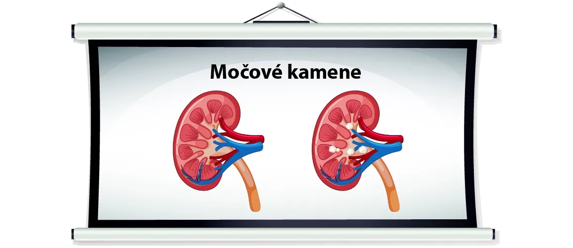 Močové kamene – prečo a ako vzniká urolitiáza?